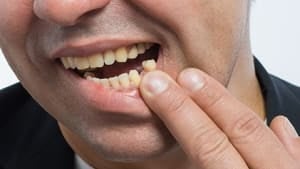 Ausgeschlagener Zahn